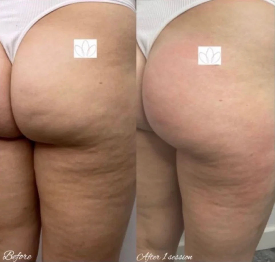 Body Sculpting