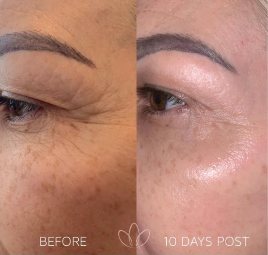 Fibroblast Plasma Blaze