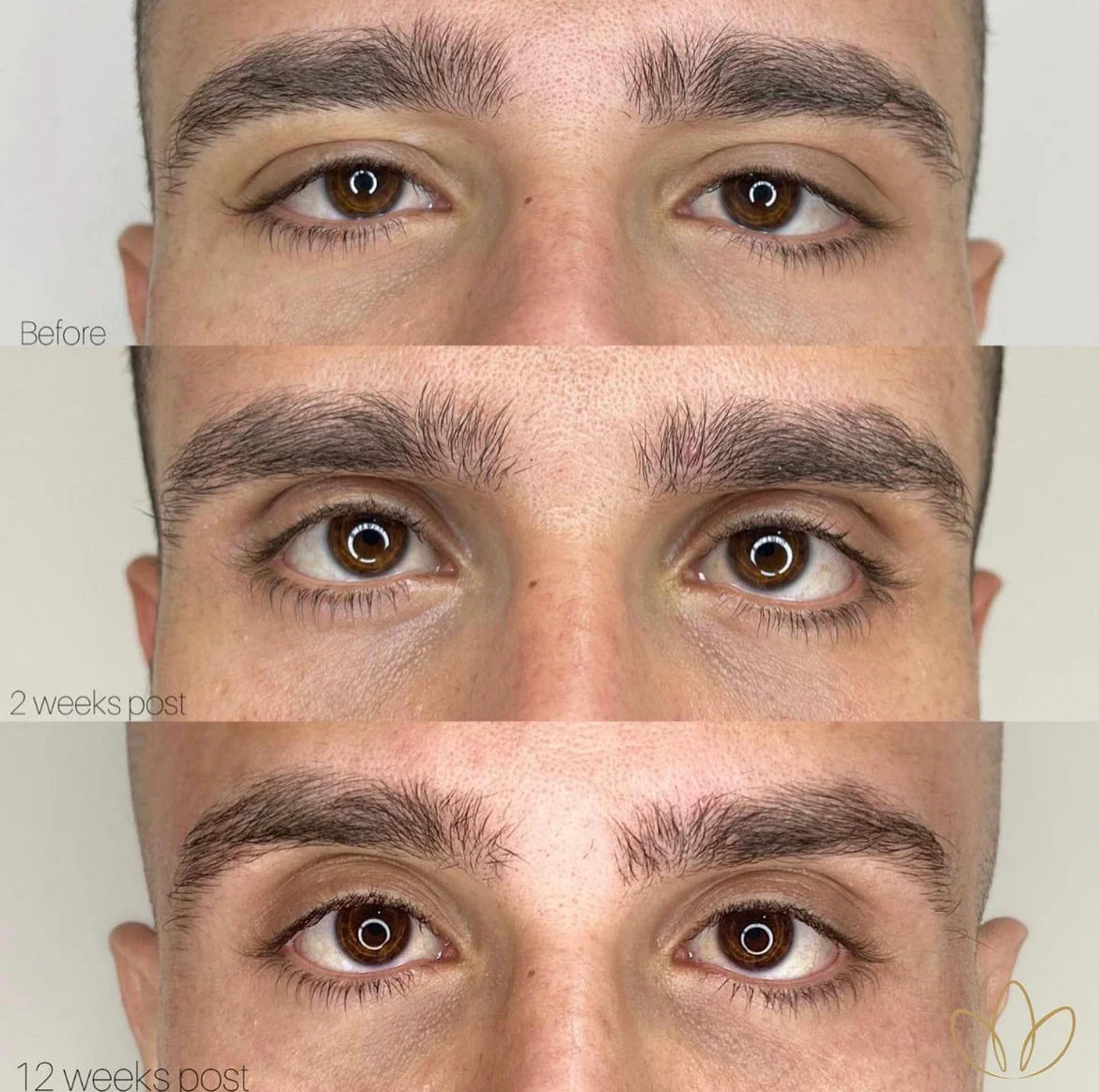 Fibroblast Plasma Blaze