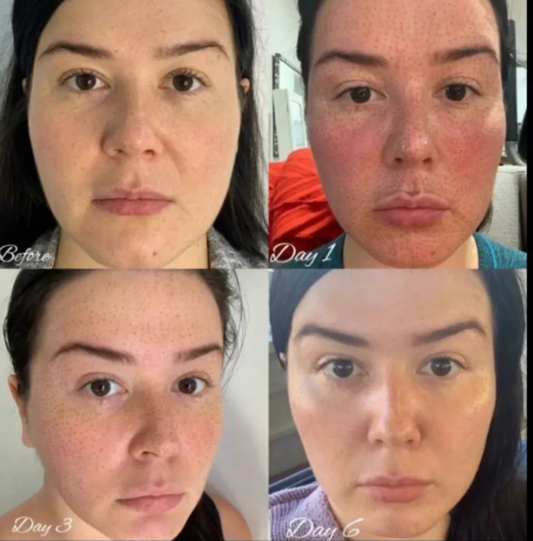 Fibroblast Plasma Blaze
