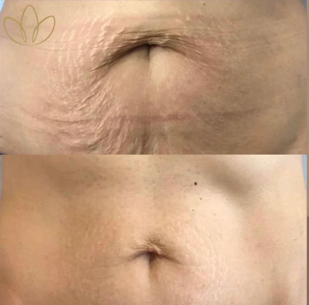 Fibroblast Plasma Blaze