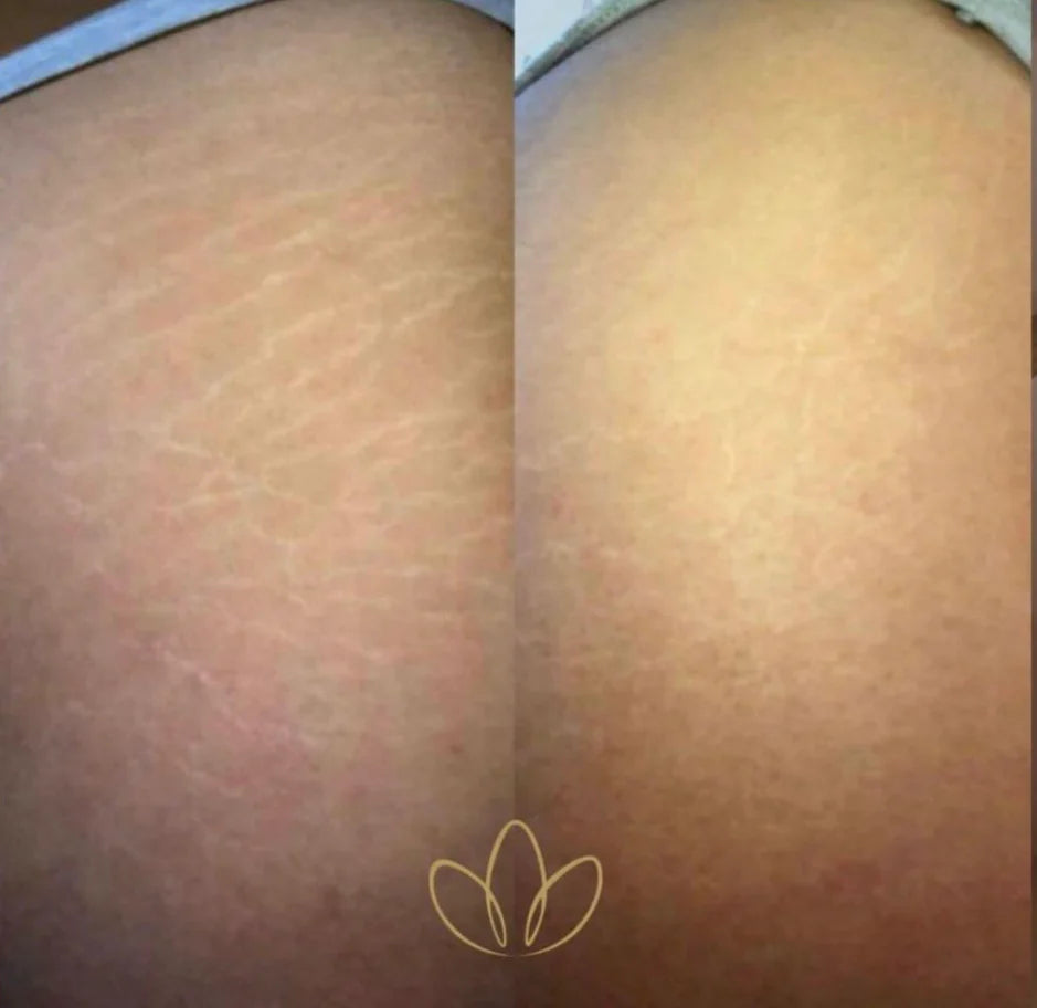 Fibroblast Plasma Blaze