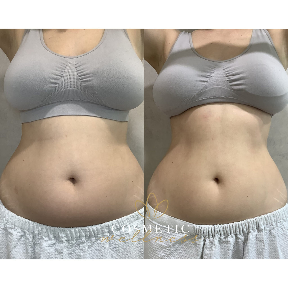HIFU Package - Cosmetic Wellness Skin Care Clinic Sydney