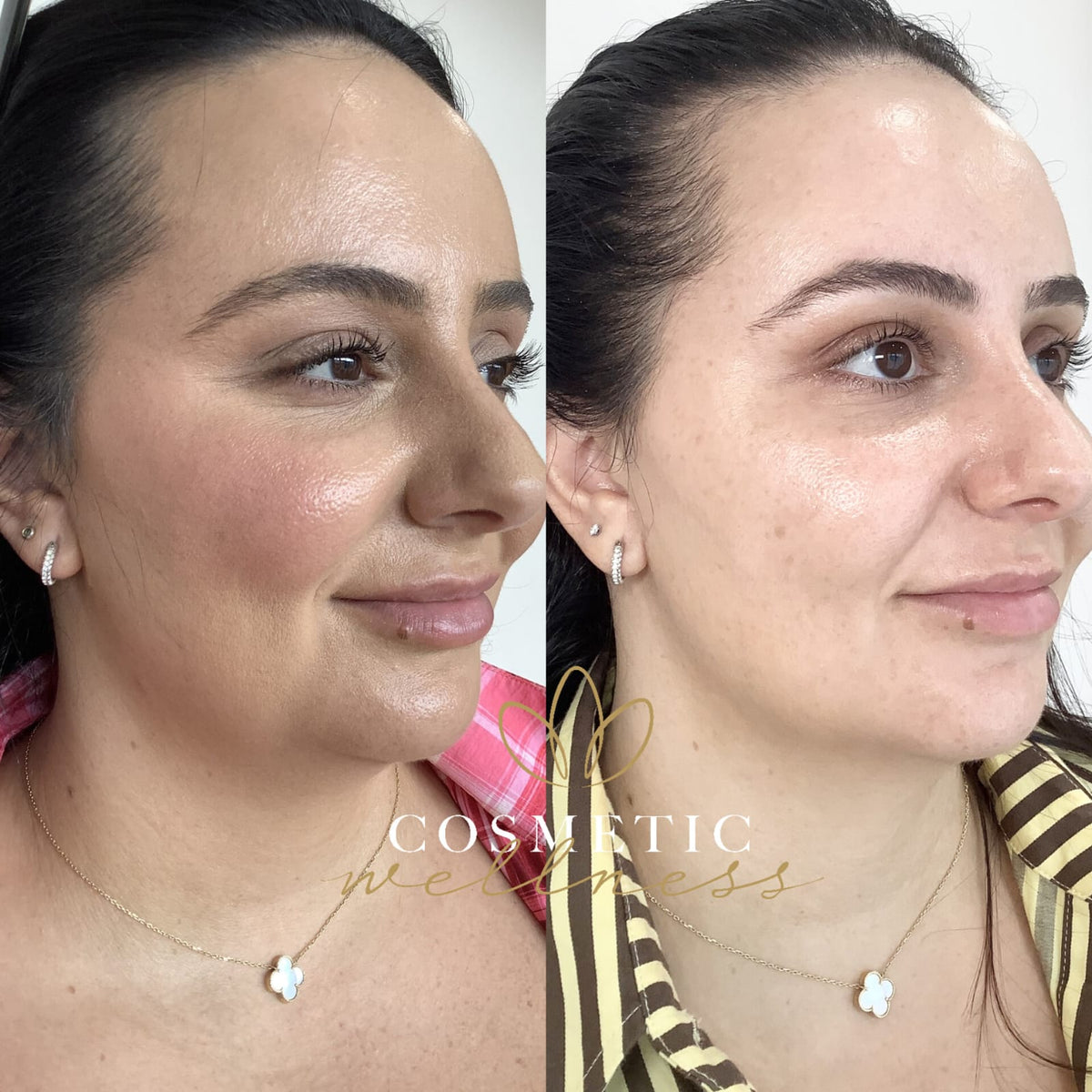 HIFU Package - Cosmetic Wellness Skin Care Clinic Sydney
