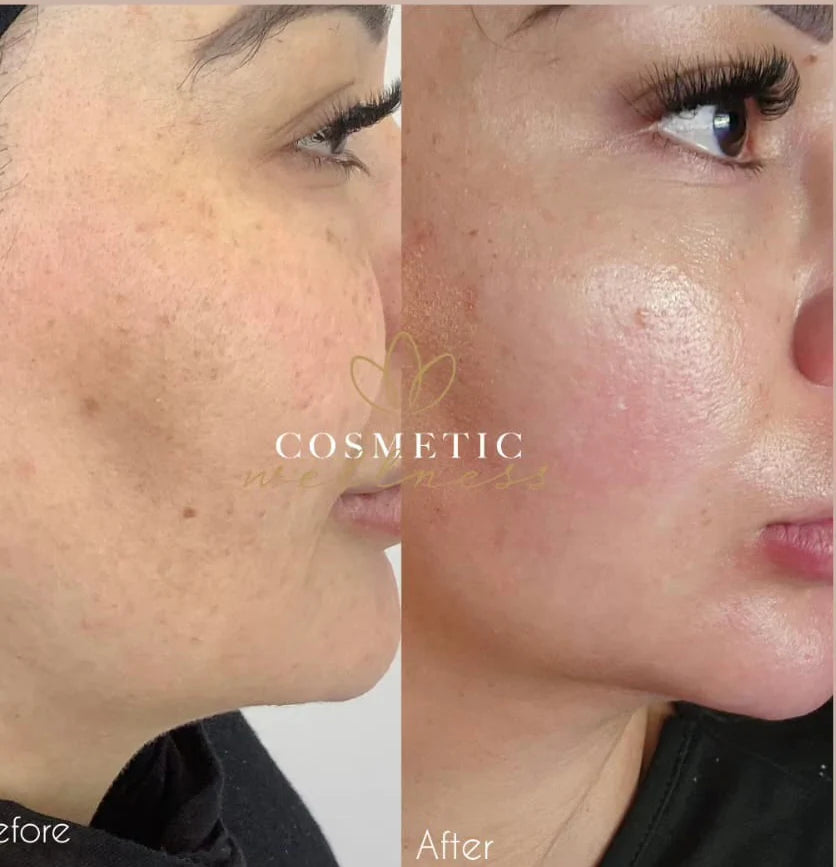 Lumecca Package - Cosmetic Wellness Skin Care Clinic Sydney