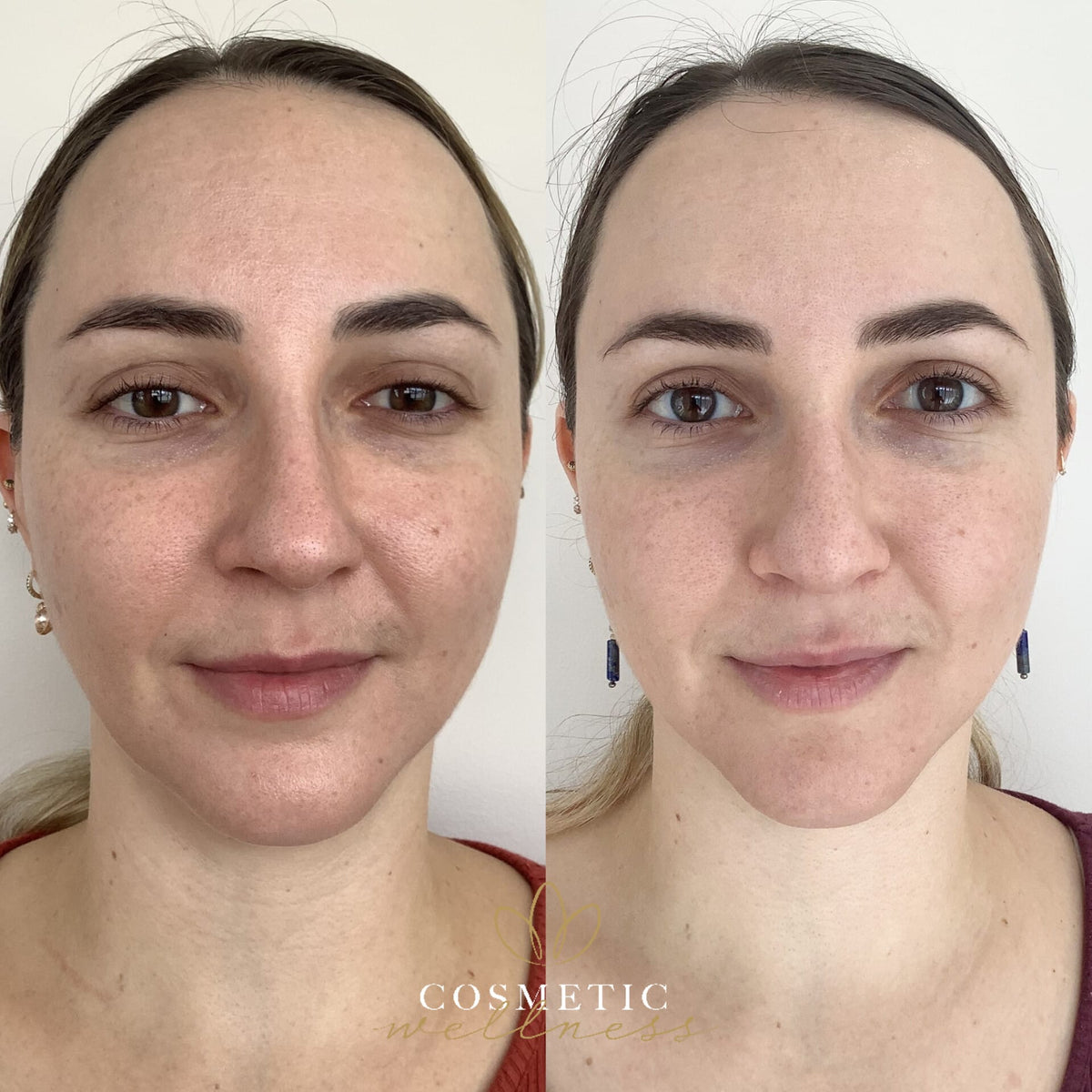 Lumecca Package - Cosmetic Wellness Skin Care Clinic Sydney