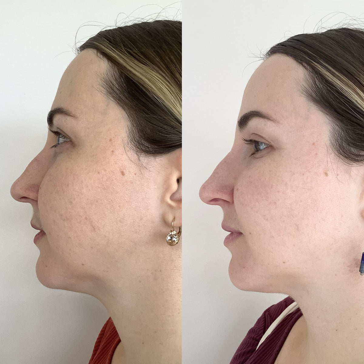 Lumecca Package - Cosmetic Wellness Skin Care Clinic Sydney