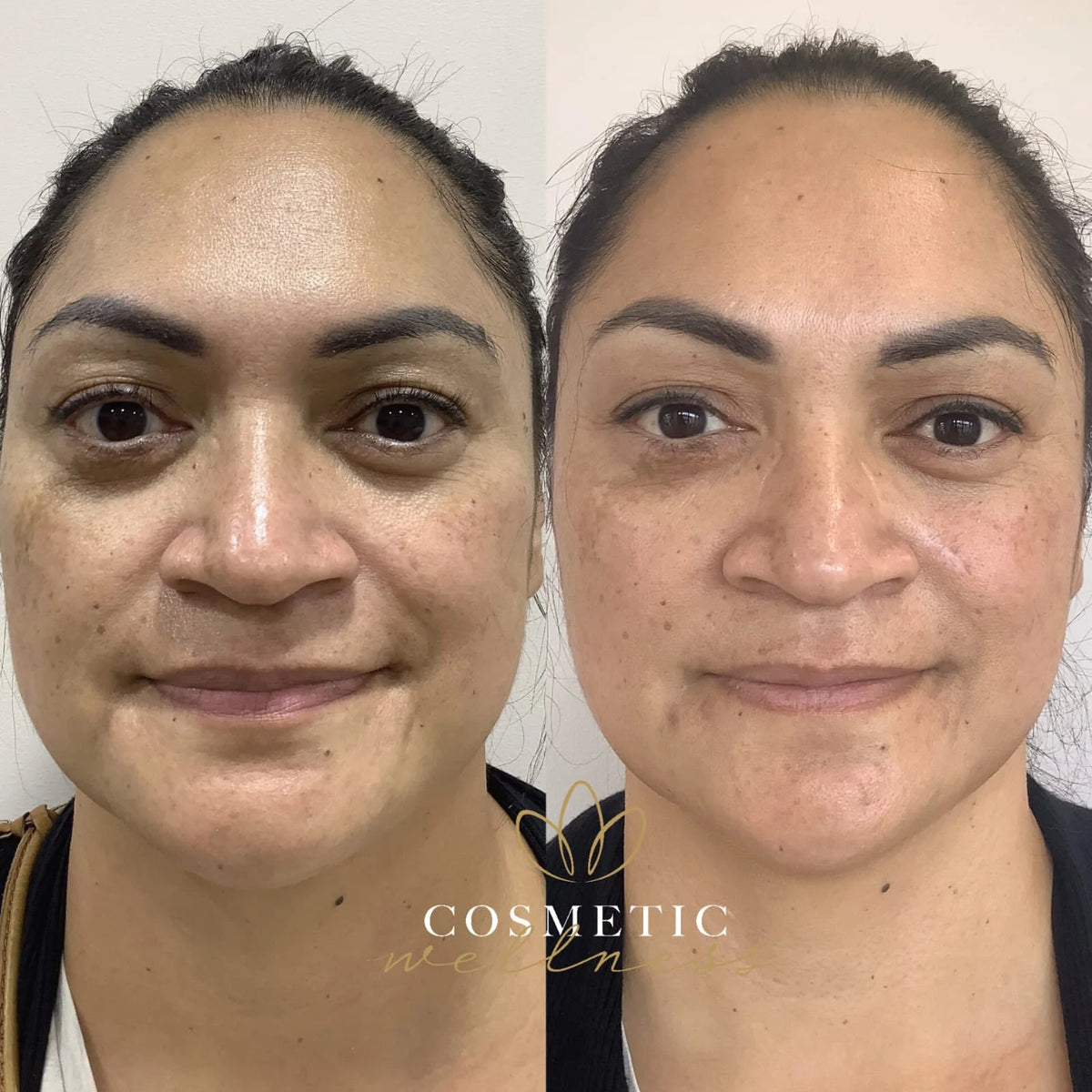 Morpheus8 Packages - Cosmetic Wellness Skin Care Clinic Sydney