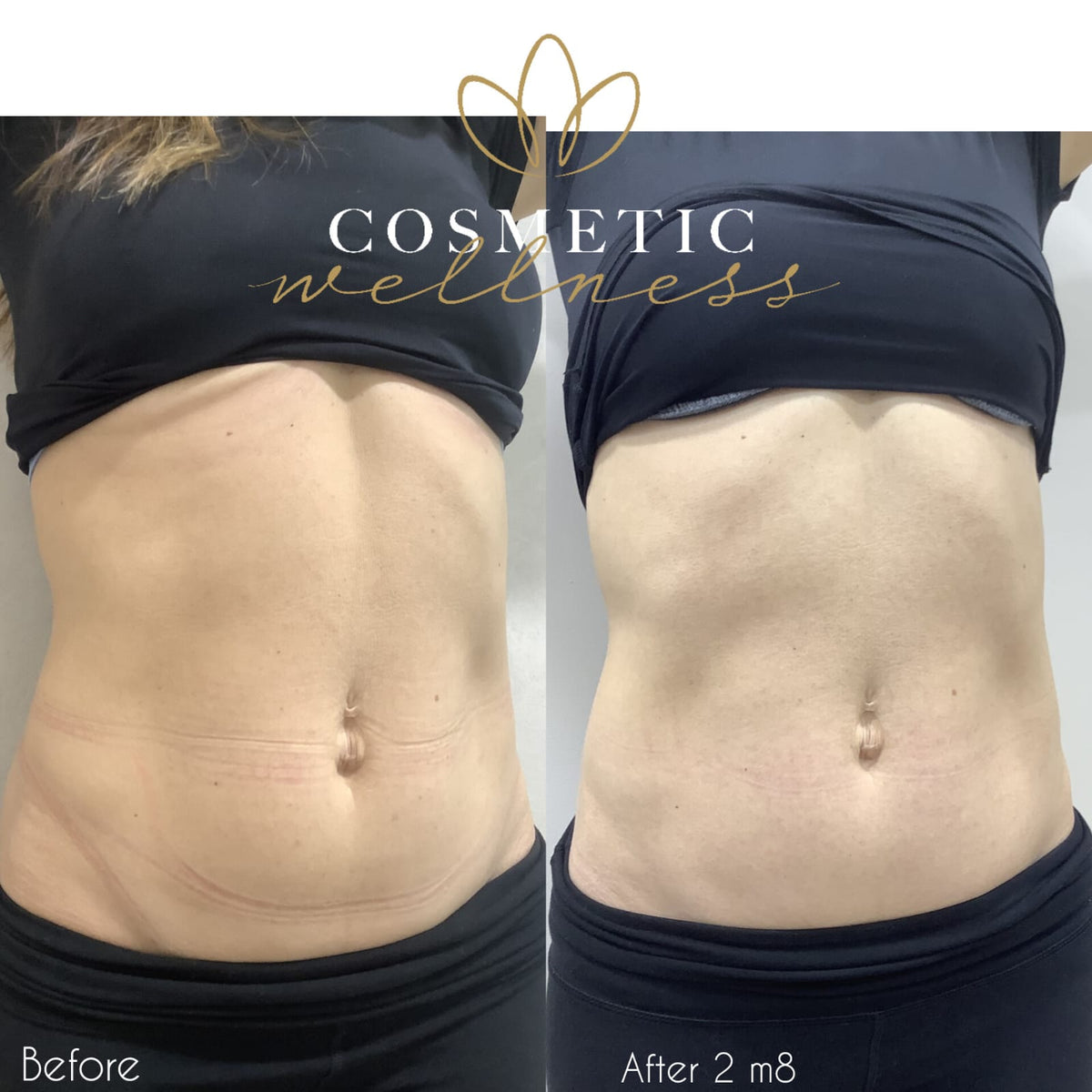 Morpheus8 Packages - Cosmetic Wellness Skin Care Clinic Sydney